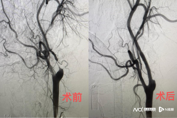 信钰证券  广东省人民医院成功开展华南首例颈动脉狭窄治疗新技术